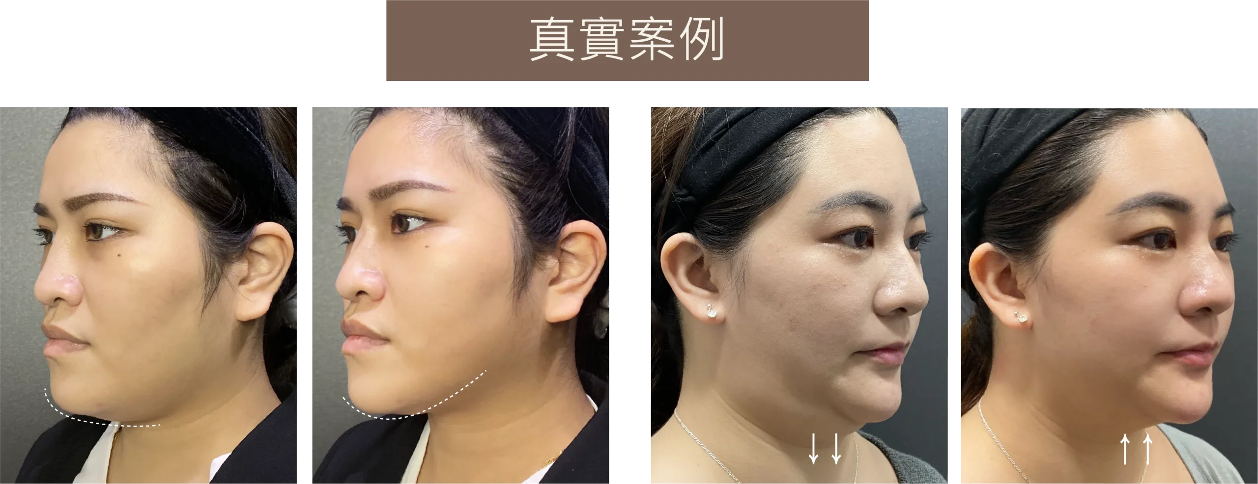 容脂針消除雙下巴真實案例對比照。展示兩位女性患者在治療後，雙下巴脂肪明顯減少，下顎輪廓線條更加明顯與緊實的改善成果。