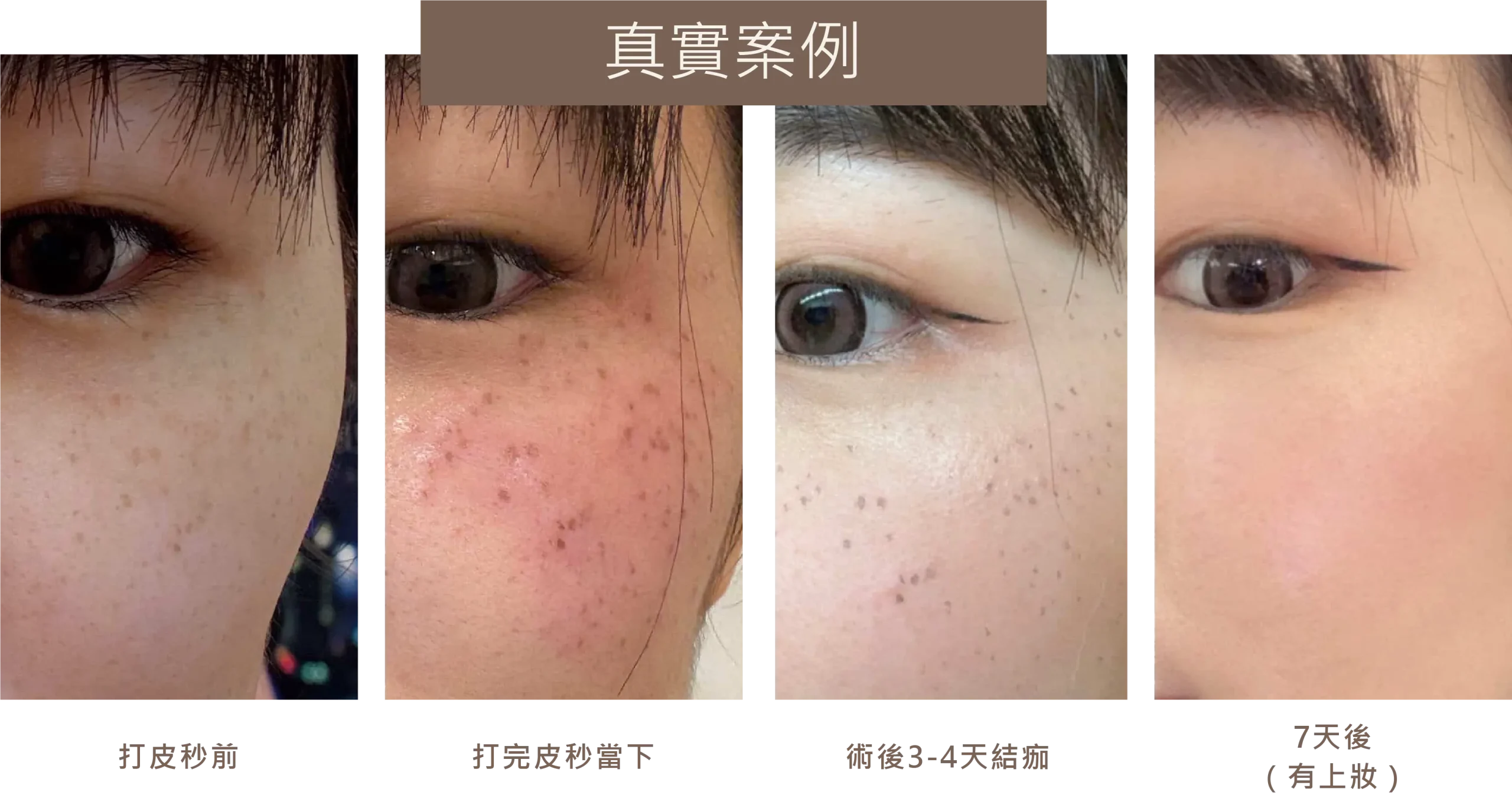 皮秒雷射消除斑點的真實案例對比照。依序呈現打皮秒前、打完皮秒當下的泛紅狀態、術後3到4天的結痂情形，以及7天後結痂脫落並上妝的淨白效果。