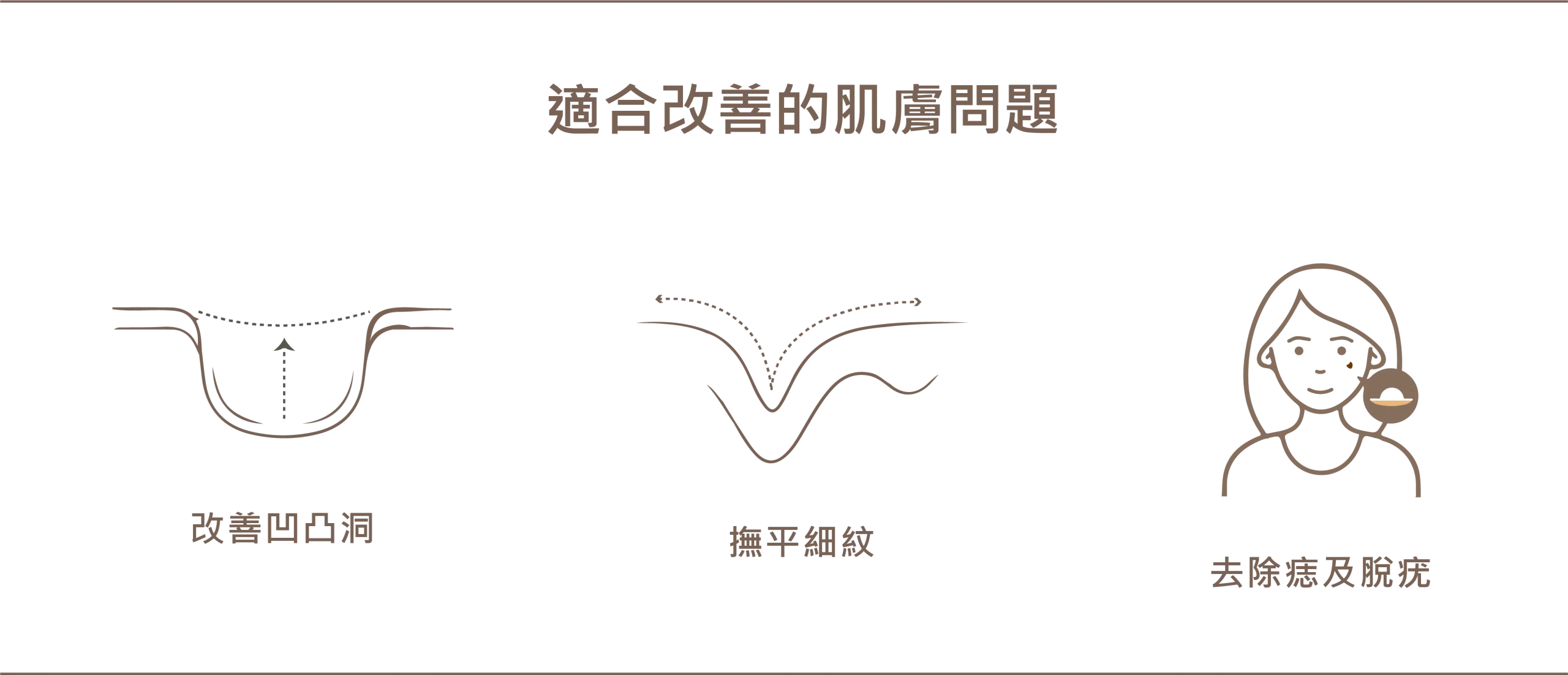 天使雷射適合改善的肌膚問題圖示，包含改善凹凸洞、撫平細紋，以及去除痣及脫疣。